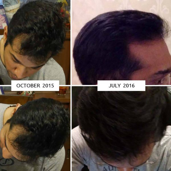 hair-growth-before-after