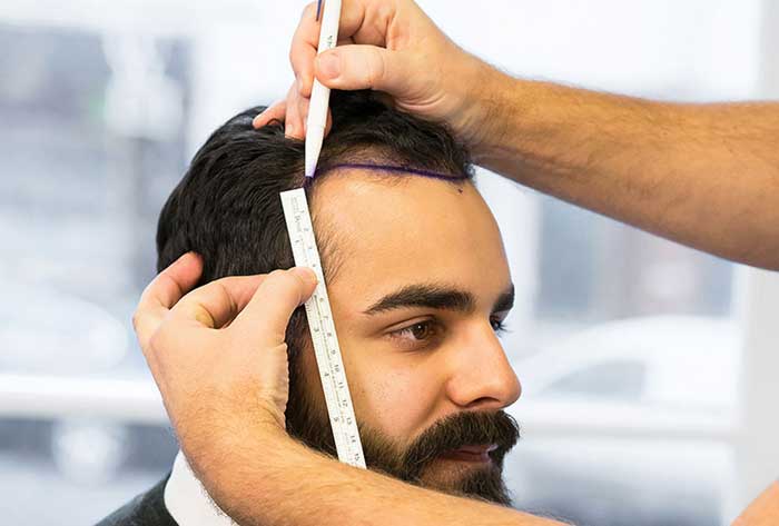 پروتز مو راحت‌تر انجام می‌شود یا کاشت مو؟