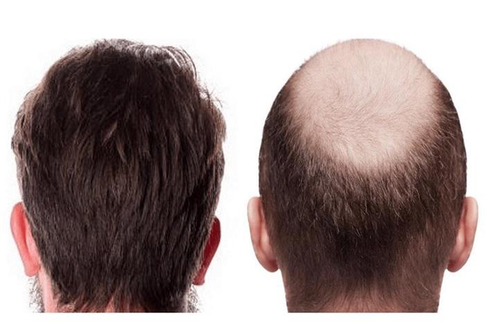تفاوت ترمیم مو و کاشت مو دقیقا در چیست؟