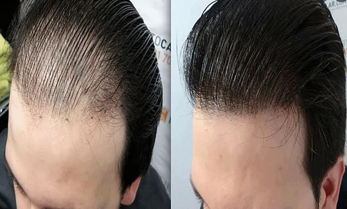 روش‌های ترمیم مو چیست