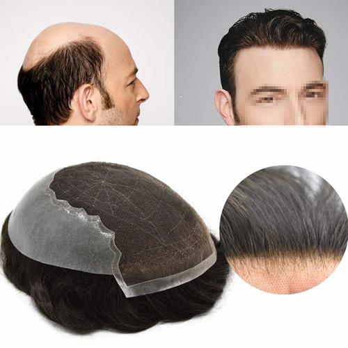 نحوه نصب پروتز مو چسبی