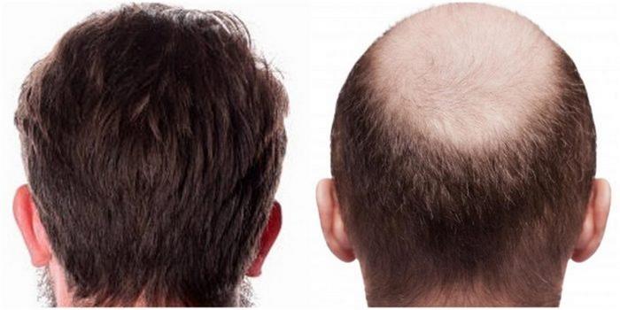 روش های ترمیم مو مردان