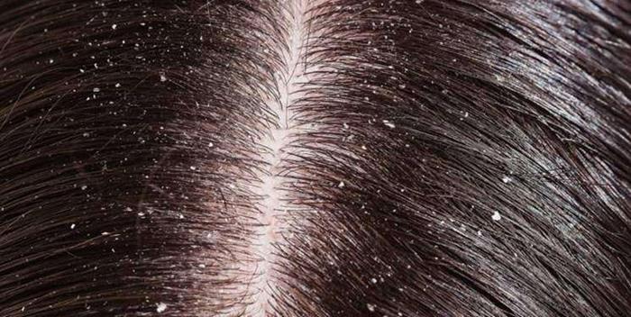 علت و نحوه درمان چربی سر بعد از کاشت مو