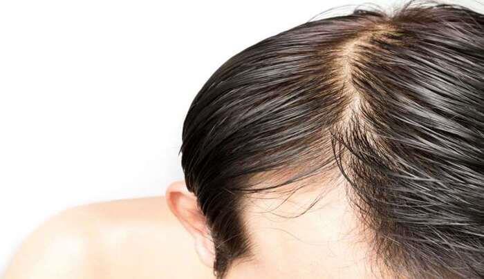 علت ترشحات پوست سر بعد از کاشت مو