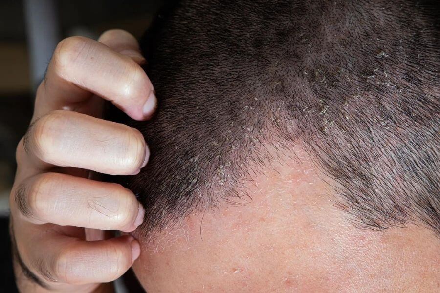 فولیکولیت مو را چطور تشخیص دهیم؟