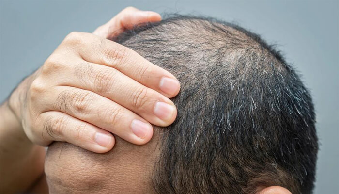 درمان کم پشتی مو در مردان