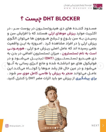 ریزش مو های ارثی