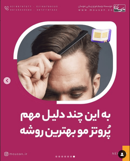 بهترین روش پروتز مو