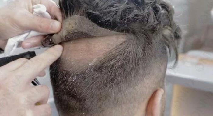مراحل تعویض چسب پروتز مو
