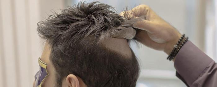 تعویض چسب پروتز مو