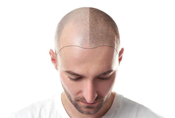 کاشت به روش fit یا fue 