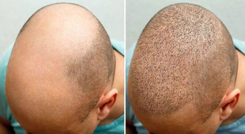 فرق کاشت fit یا fue