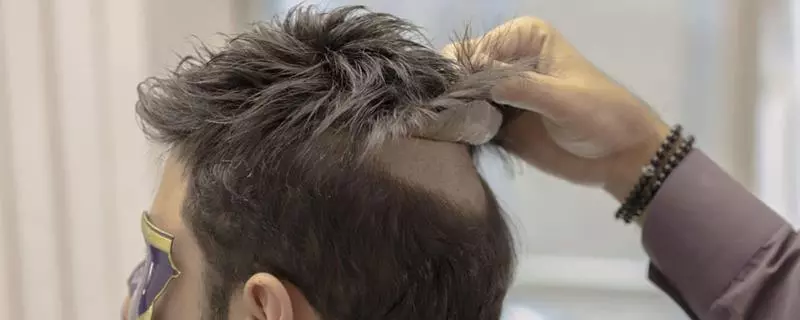 پروتز مو چسبی